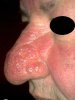 rhinophyma.jpg